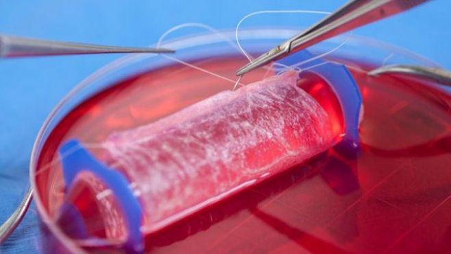 Vaginas cultivadas em laboratório são implantadas em 4 mulheres pela primeira vez